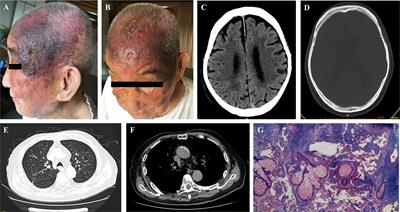 Efficacy of Anlotinib for the Treatment of Angiosarcoma of the Face and Neck: A Case Report